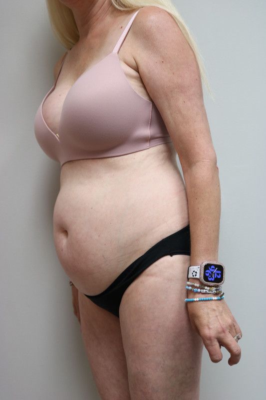 Abdominoplasty Before & After