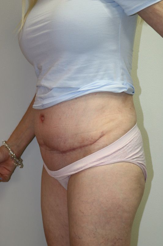 Abdominoplasty Before & After