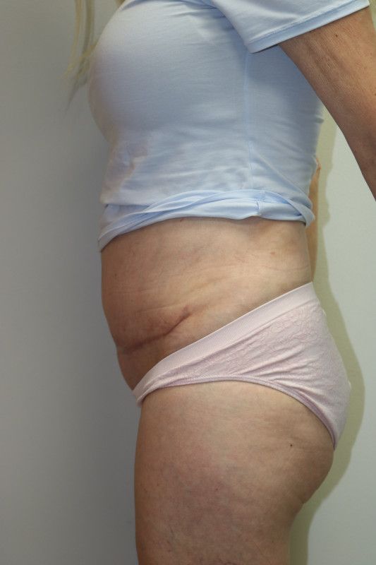 Abdominoplasty Before & After