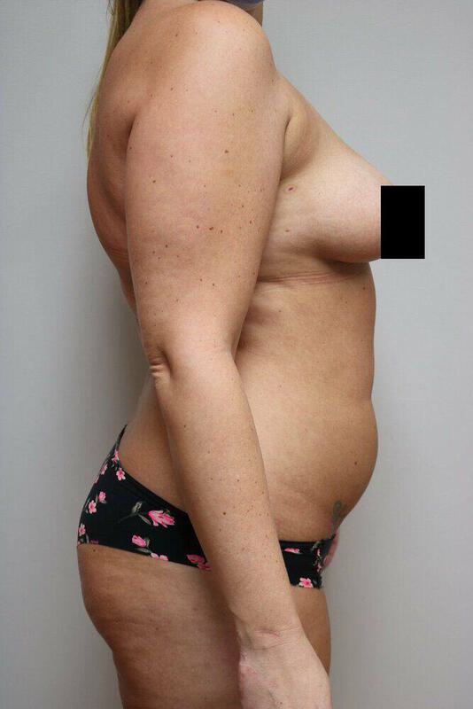 Liposuction Before & After Image