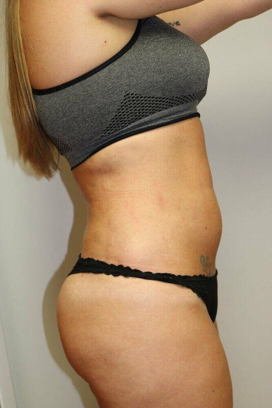 Liposuction Before & After Image