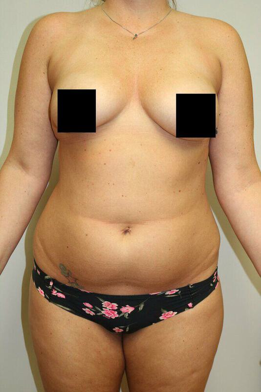 Liposuction Before & After Image