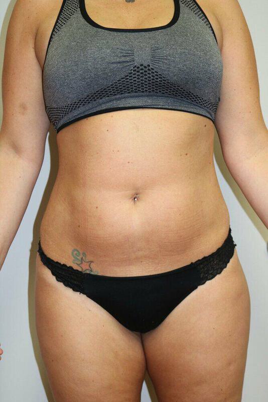 Liposuction Before & After Image