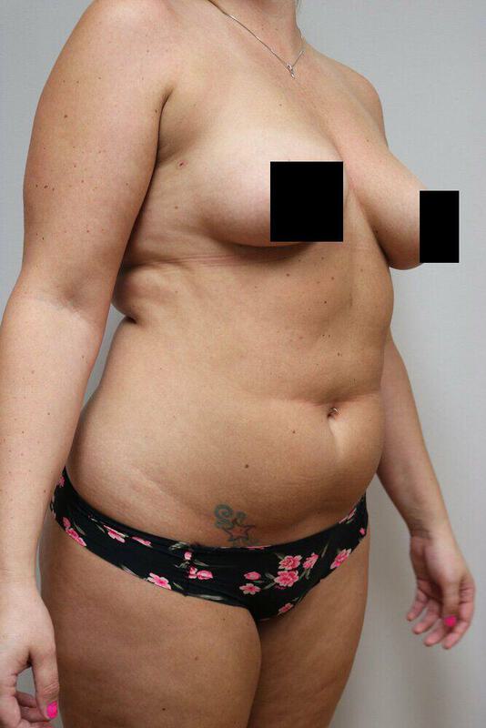 Liposuction Before & After Image