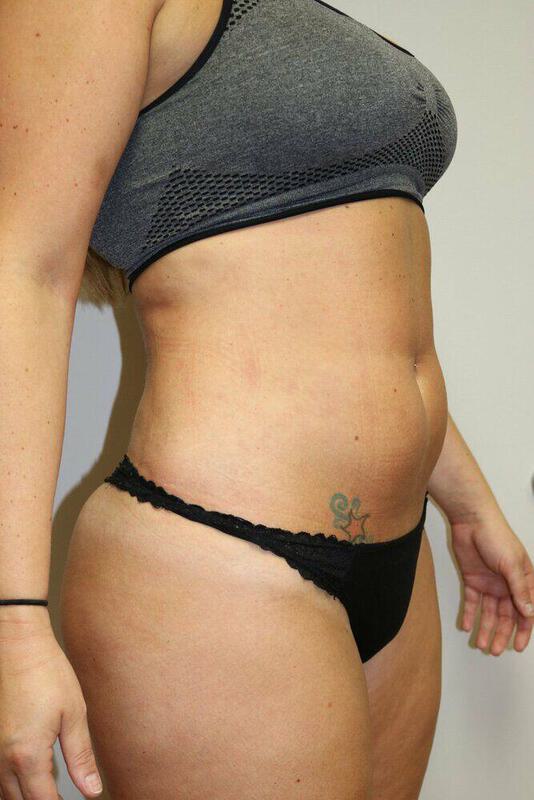 Liposuction Before & After Image