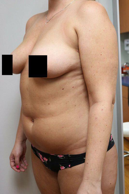 Liposuction Before & After Image