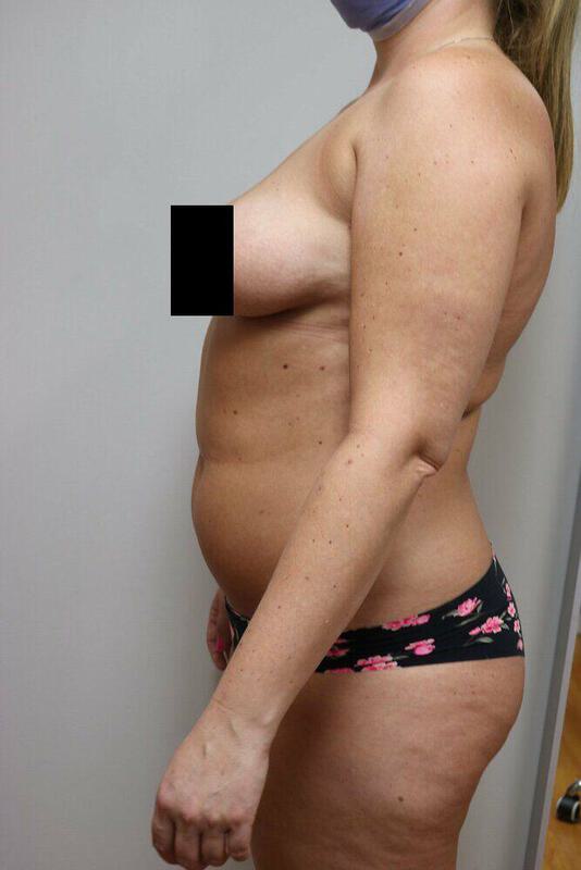 Liposuction Before & After Image