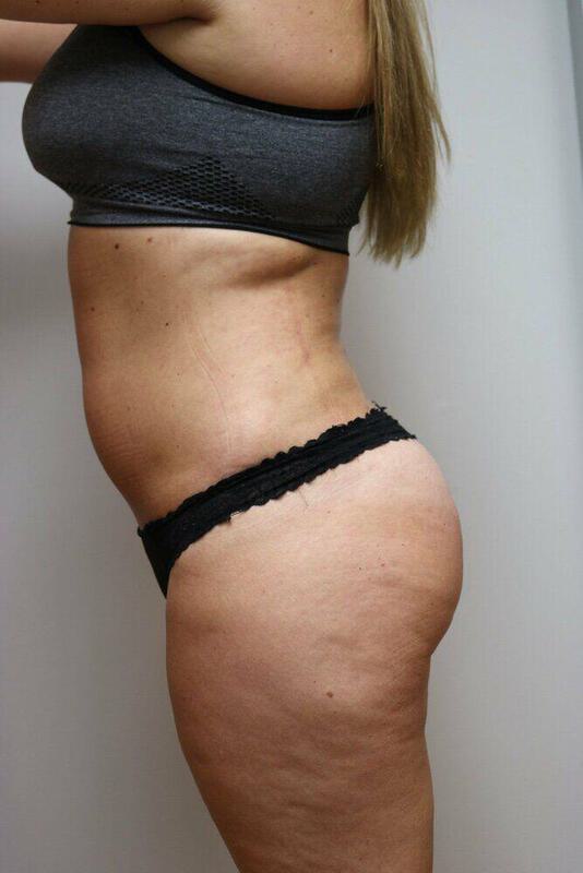 Liposuction Before & After Image