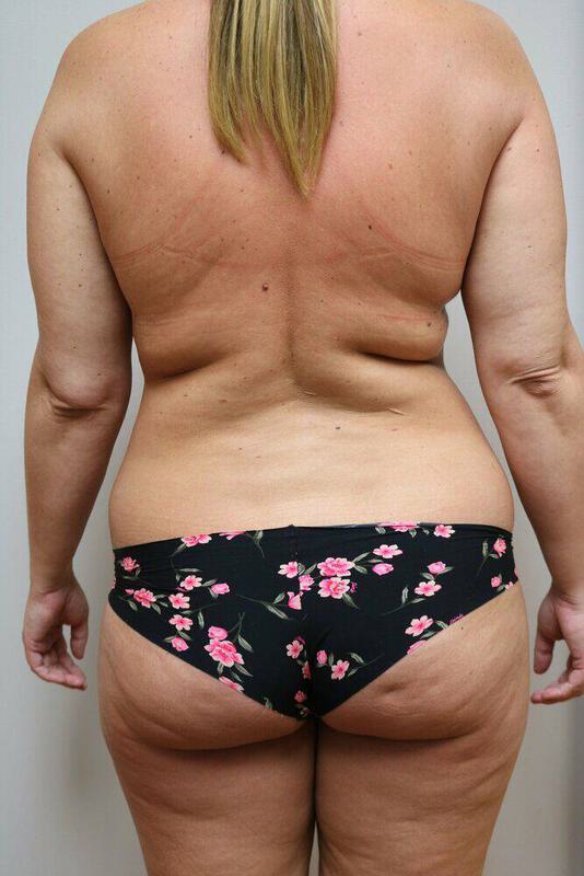 Liposuction Before & After Image