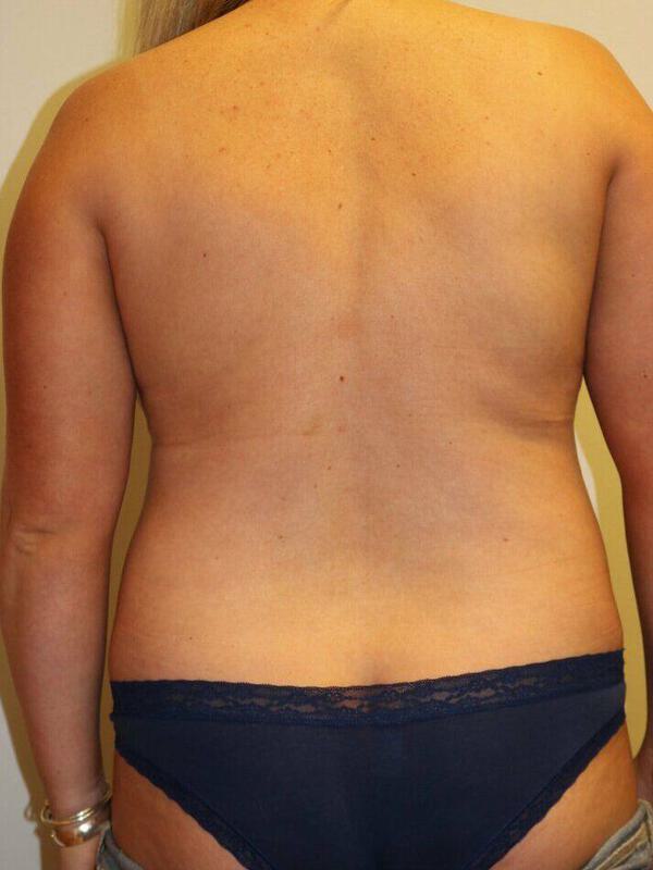 Liposuction Before & After Image