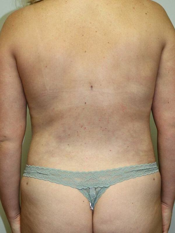 Liposuction Before & After Image