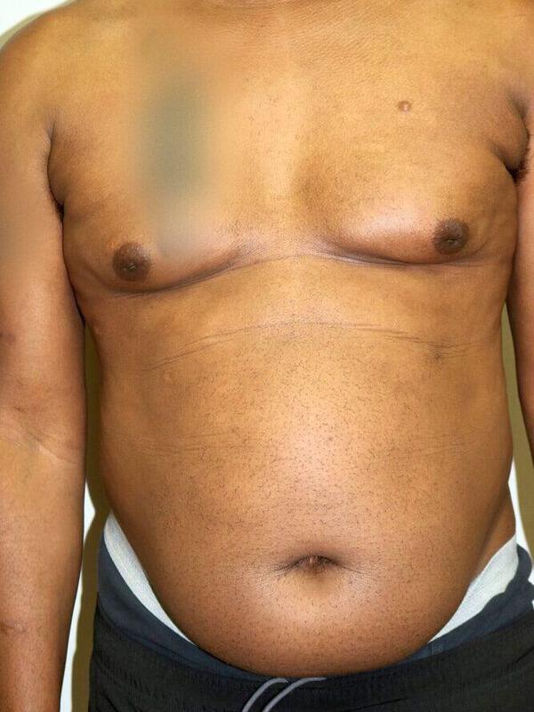 Liposuction Before & After Image