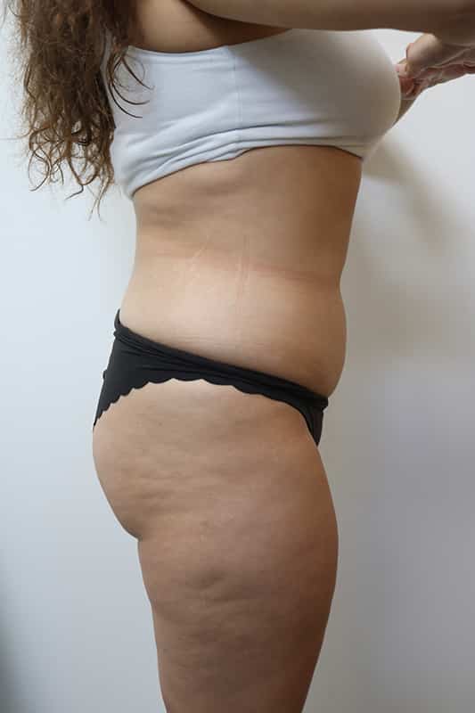 Liposuction Before & After Image