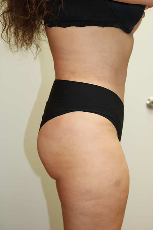 Liposuction Before & After Image