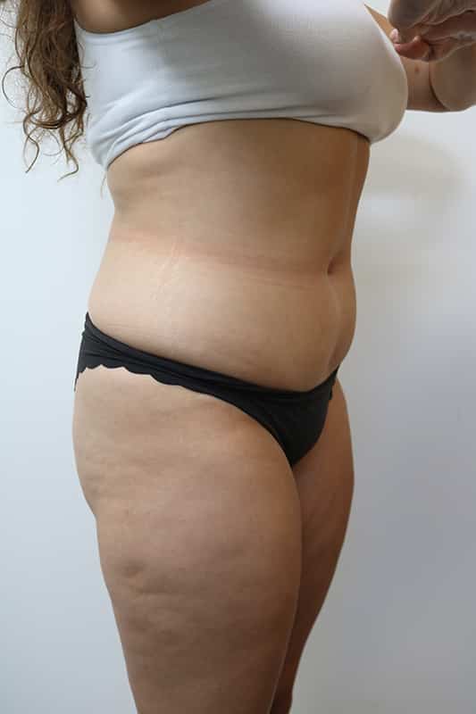 Liposuction Before & After Image