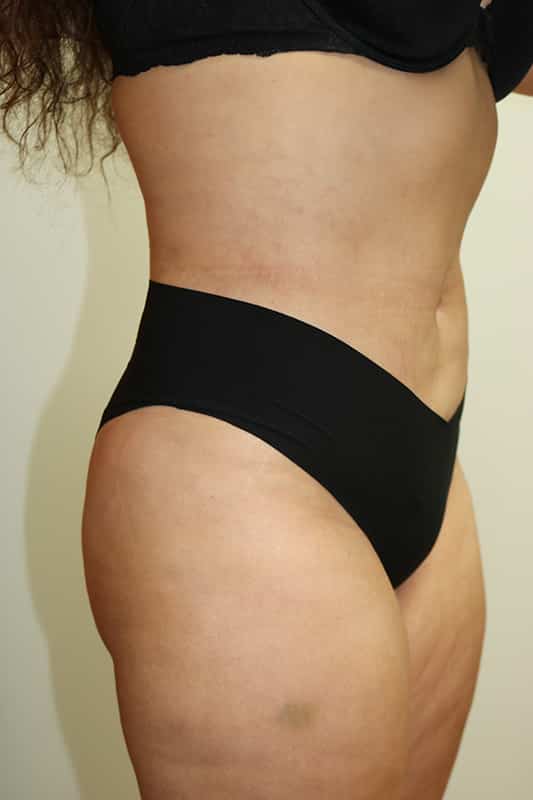 Liposuction Before & After Image