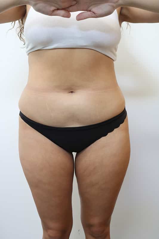 Liposuction Before & After Image