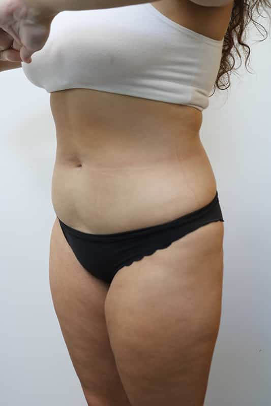 Liposuction Before & After Image