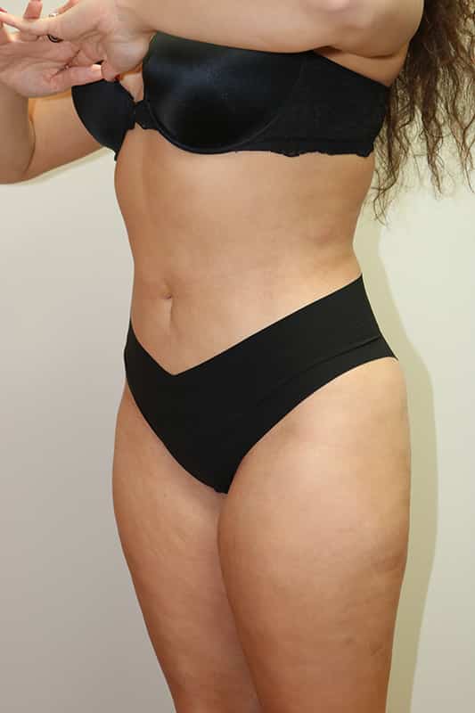 Liposuction Before & After Image