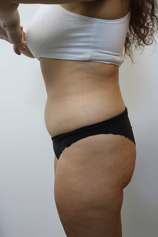 Liposuction Before & After Image