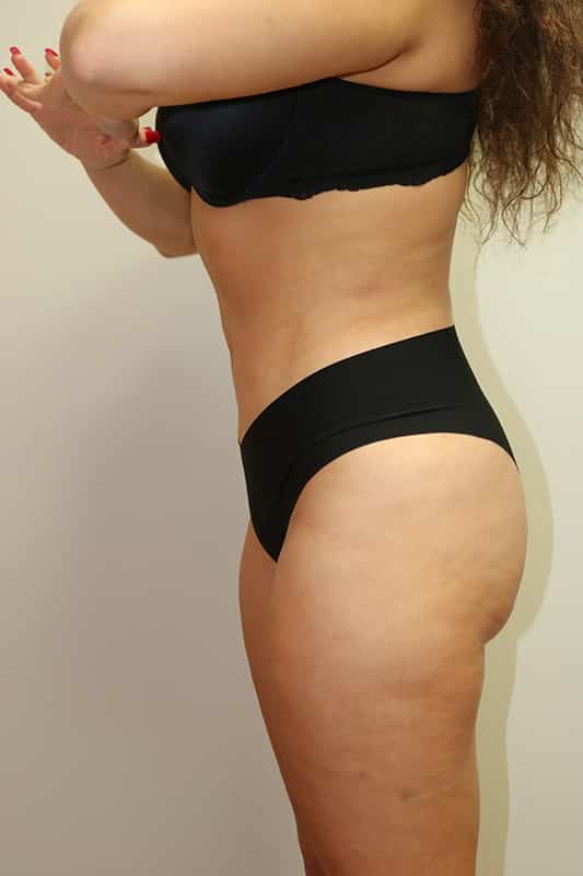 Liposuction Before & After Image