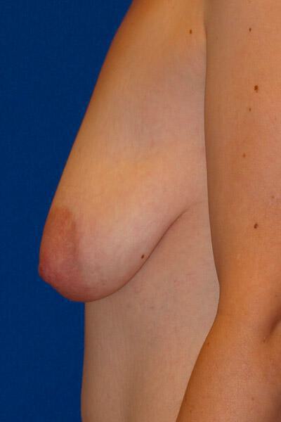 Breast Augmentation With Lift Before & After Image
