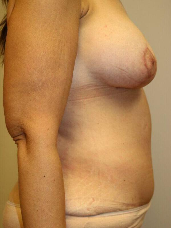 Breast Augmentation With Lift Before & After Image