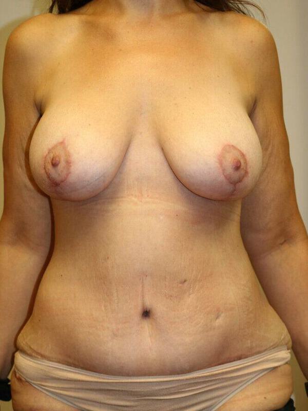 Breast Augmentation With Lift Before and After 03 | ARC Plastic Surgery