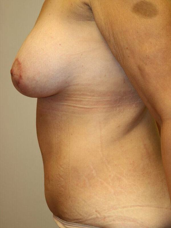 Breast Augmentation With Lift Before & After Image