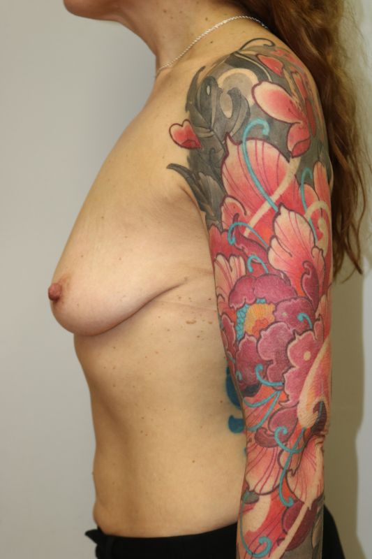 Breast Augmentation With Lift Before & After