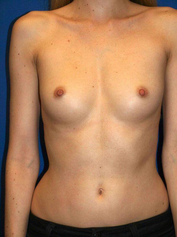 Breast Augmentation Before & After Image