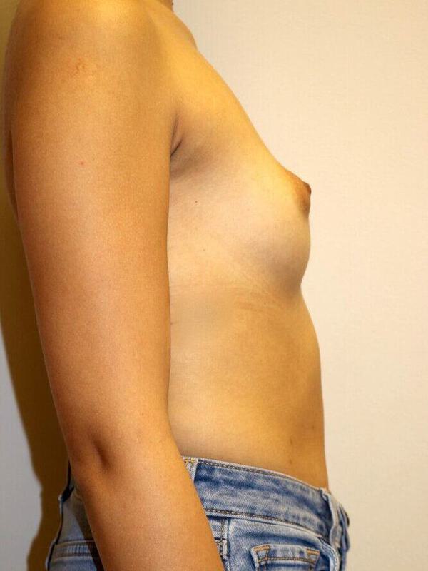 Breast Augmentation Before & After Image