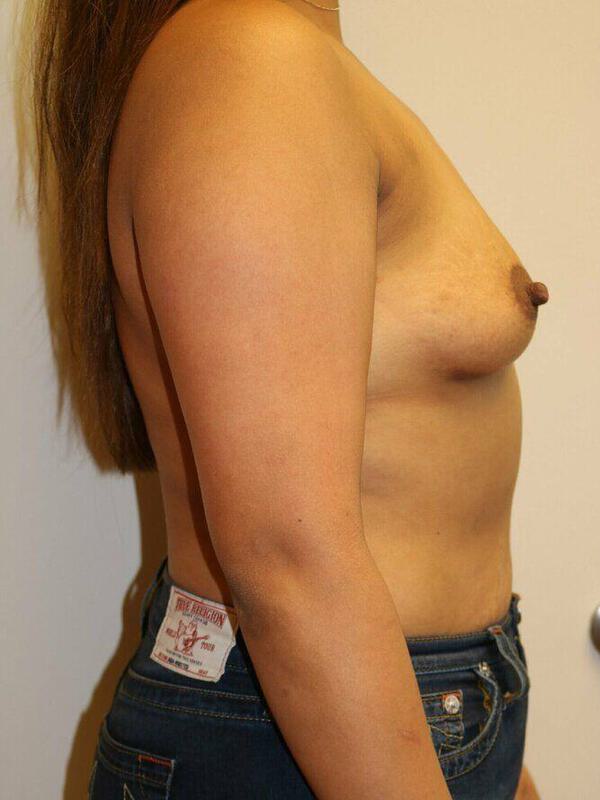 Breast Augmentation Before & After Image