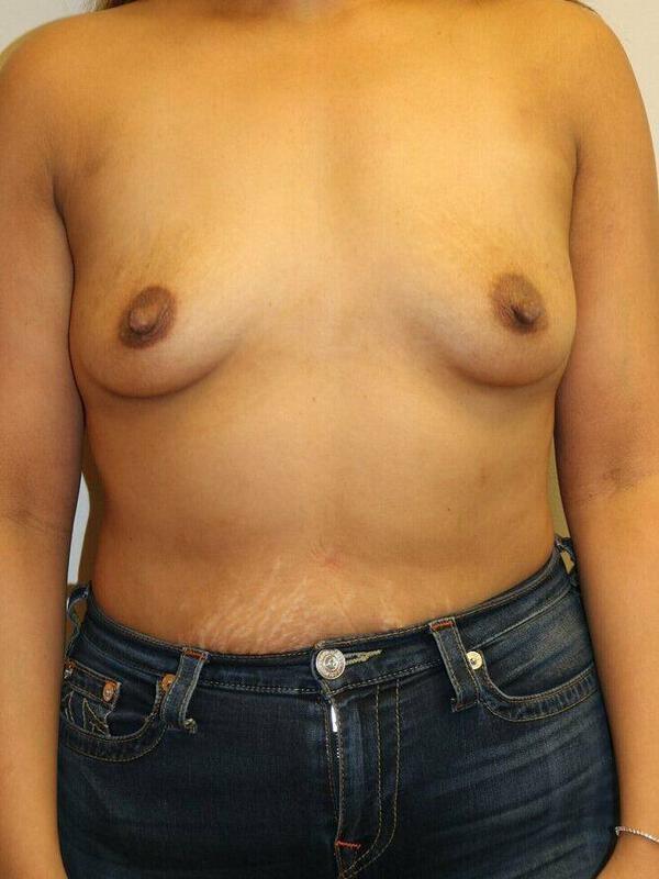 Breast Augmentation Before & After Image