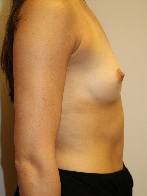 Breast Augmentation Before & After Image