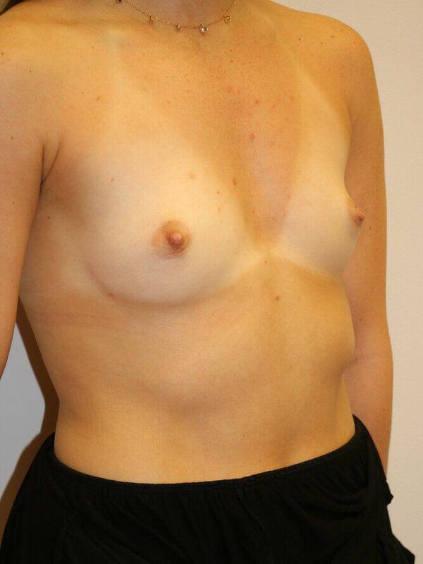 Breast Augmentation Before & After Image