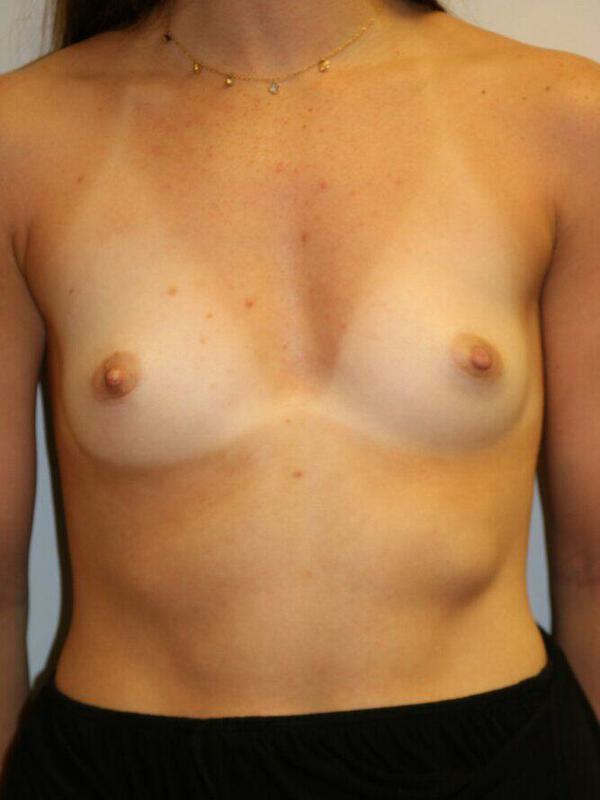 Breast Augmentation Before & After Image