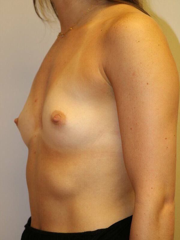 Breast Augmentation Before & After Image