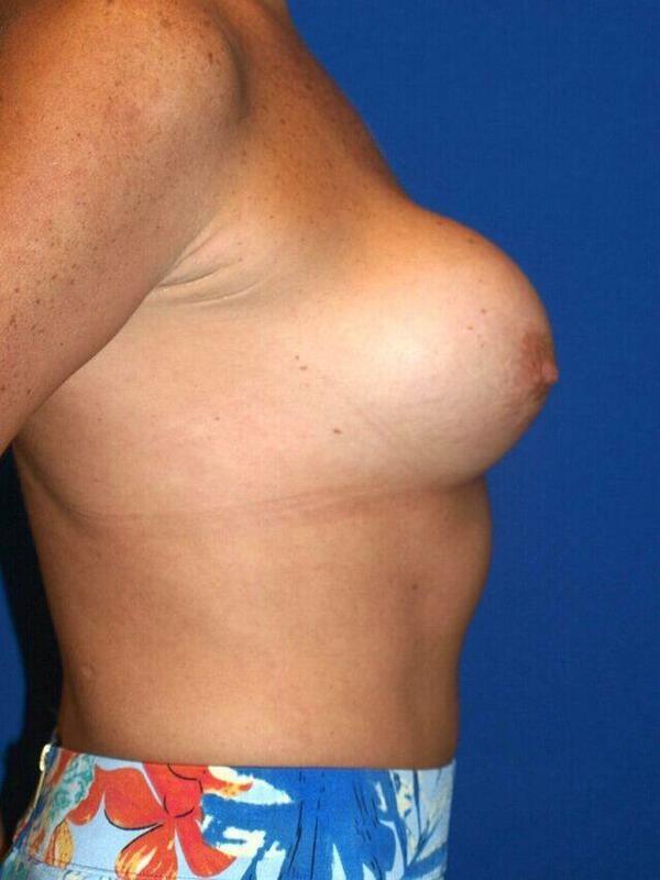 Breast Augmentation Before & After Image