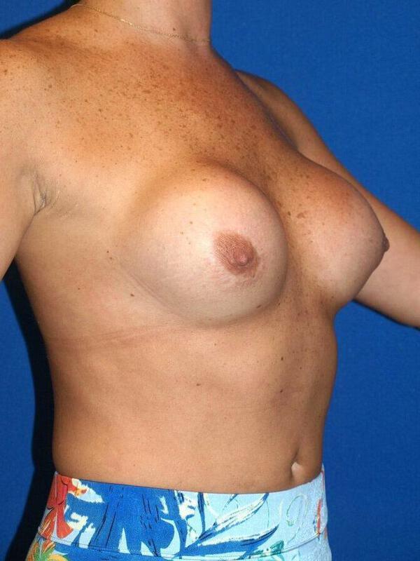 Breast Augmentation Before & After Image