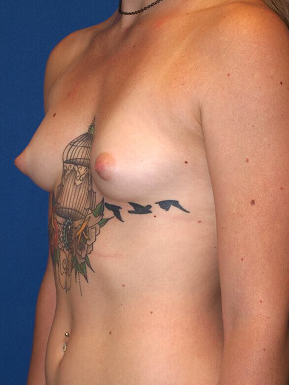 Breast Augmentation Before & After Image