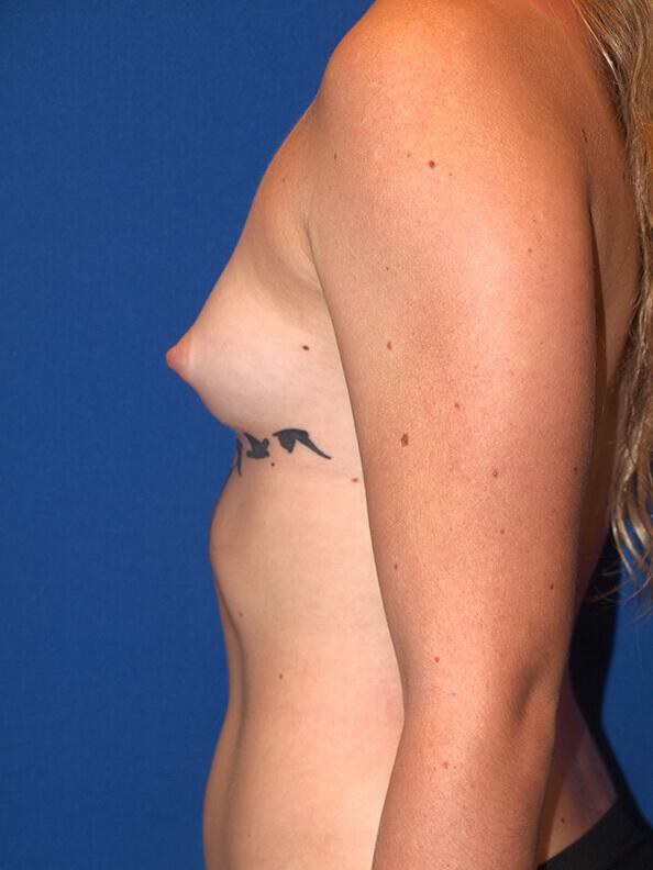 Breast Augmentation Before & After Image