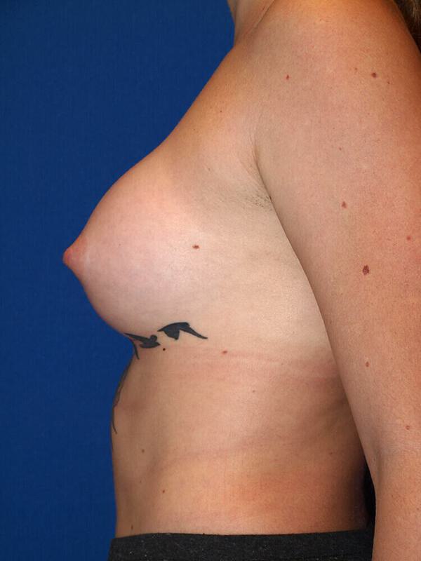 Breast Augmentation Before & After Image