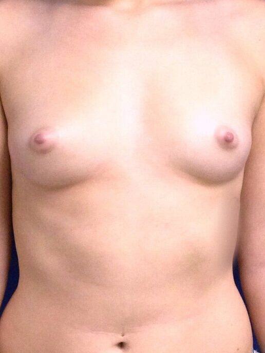 Breast Augmentation Before & After Image