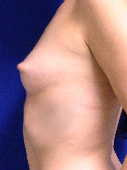 Breast Augmentation Before & After Image