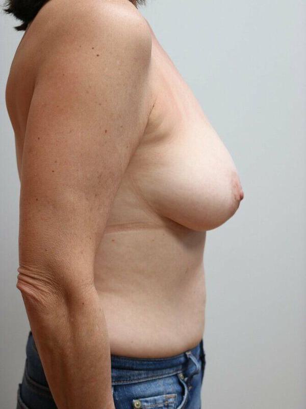 Breast Lift Before & After Image