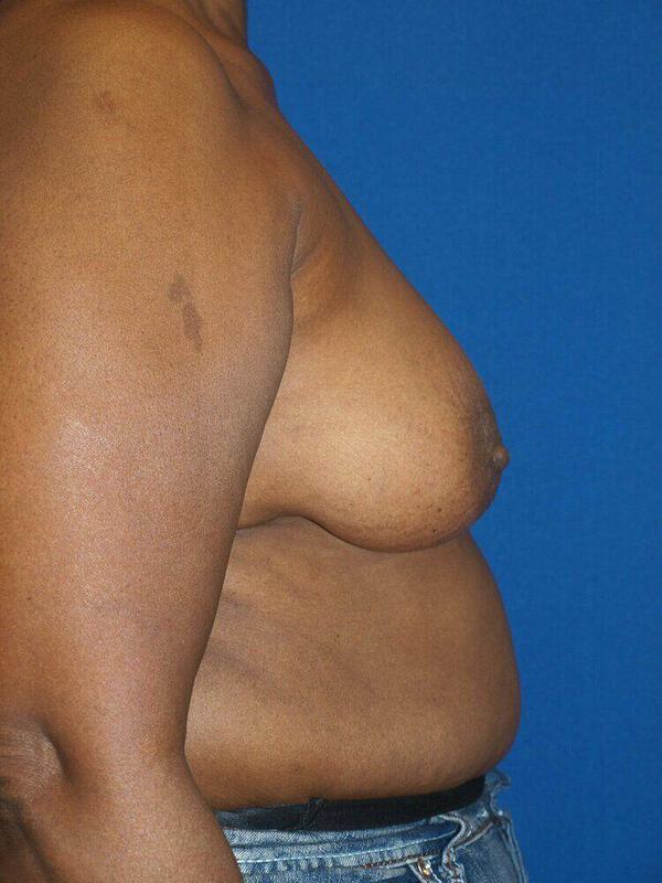 Breast Lift Before & After Image