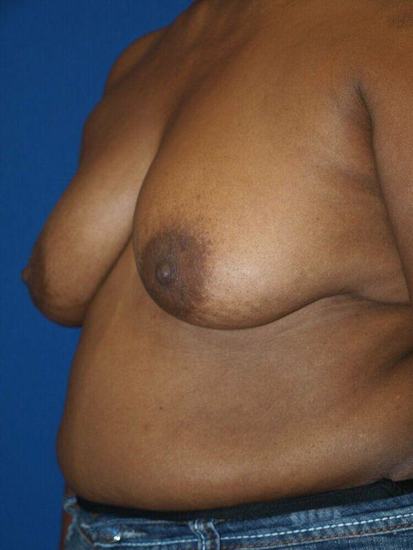 Breast Lift Before & After Image