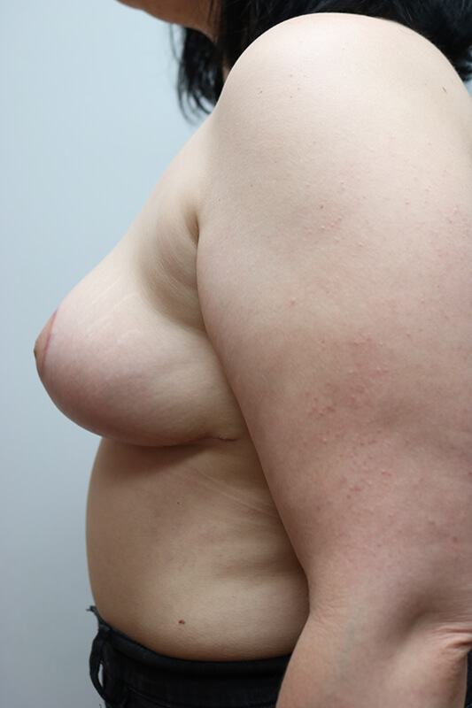 Breast Lift Before & After Image