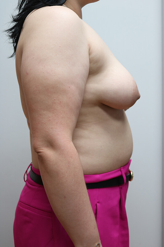 Breast Lift Before & After Image